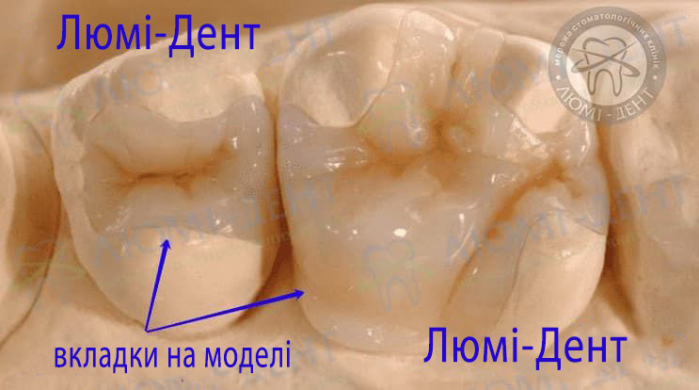 Зубна вкладка на зуби фото ЛюміДент