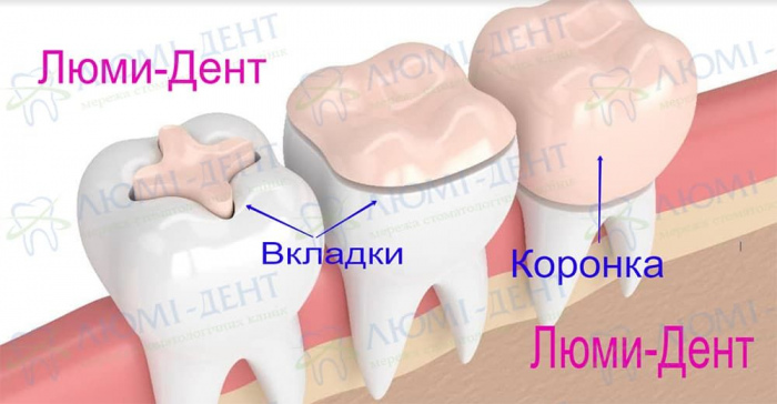 Dental crowns photo Lumi-Dent
