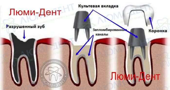 Штифтовый зуб на корень фото Люмидент 