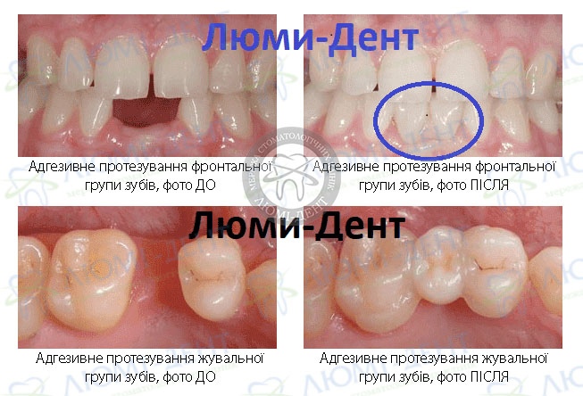 адгезивні мости фото Люмі-Дент