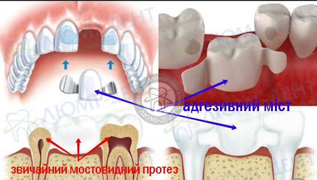 адгезивний міст Київ фото Люмі-Дент