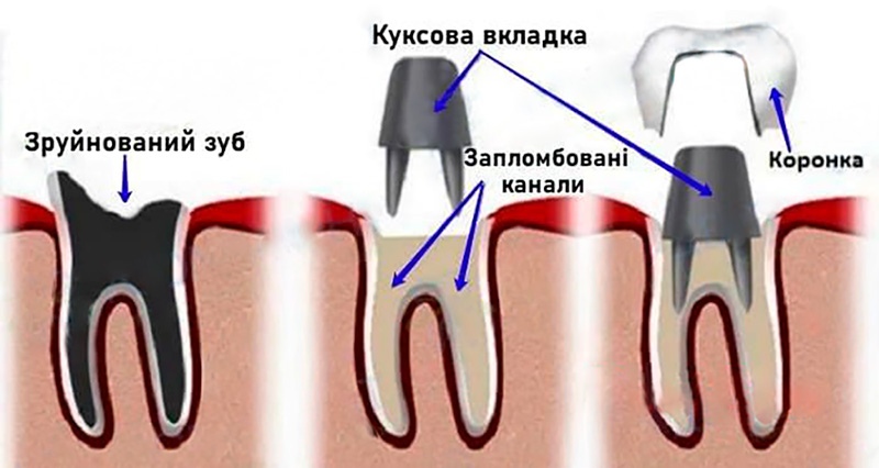 Схема штифтового зуба - куксової вкладки з коронкою Штифтовий зуб на корінь фото Люмі-Дент