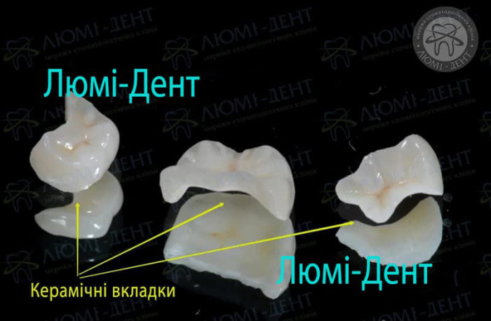 Керамічні вкладки на зуби Київ фото Люмі-Дент