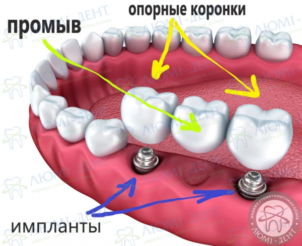 Незнімні мостоподібні протези на зуби ЛюміДент
