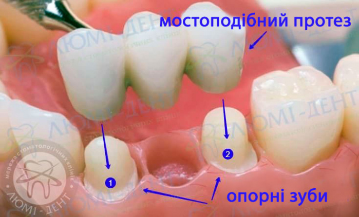 Мостоподібний протез на зуби фото Люмі-Дент