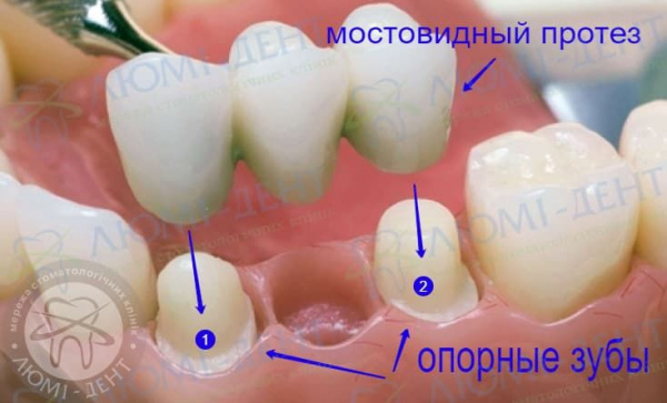 Альтернатива имплантации зубов фото Люми-Дент