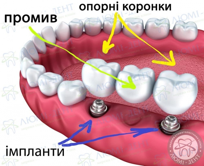 Металокерамічний міст ціна фото ЛюміДент