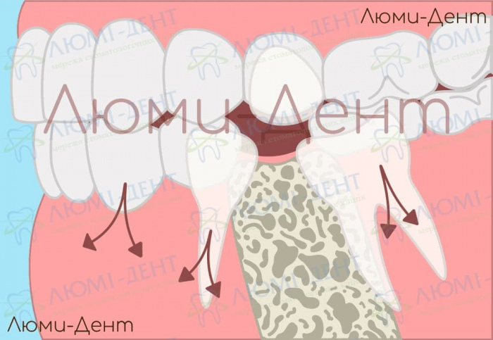 Костная имплантация зубов фото Киев Люми-Дент