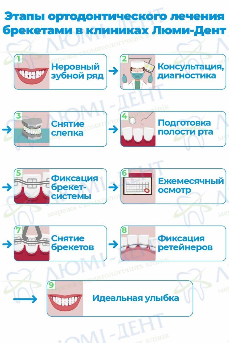 Этапы установки брекетов в клиниках Люми-Дент Этапы исправления прикуса зубов Люми-Дент