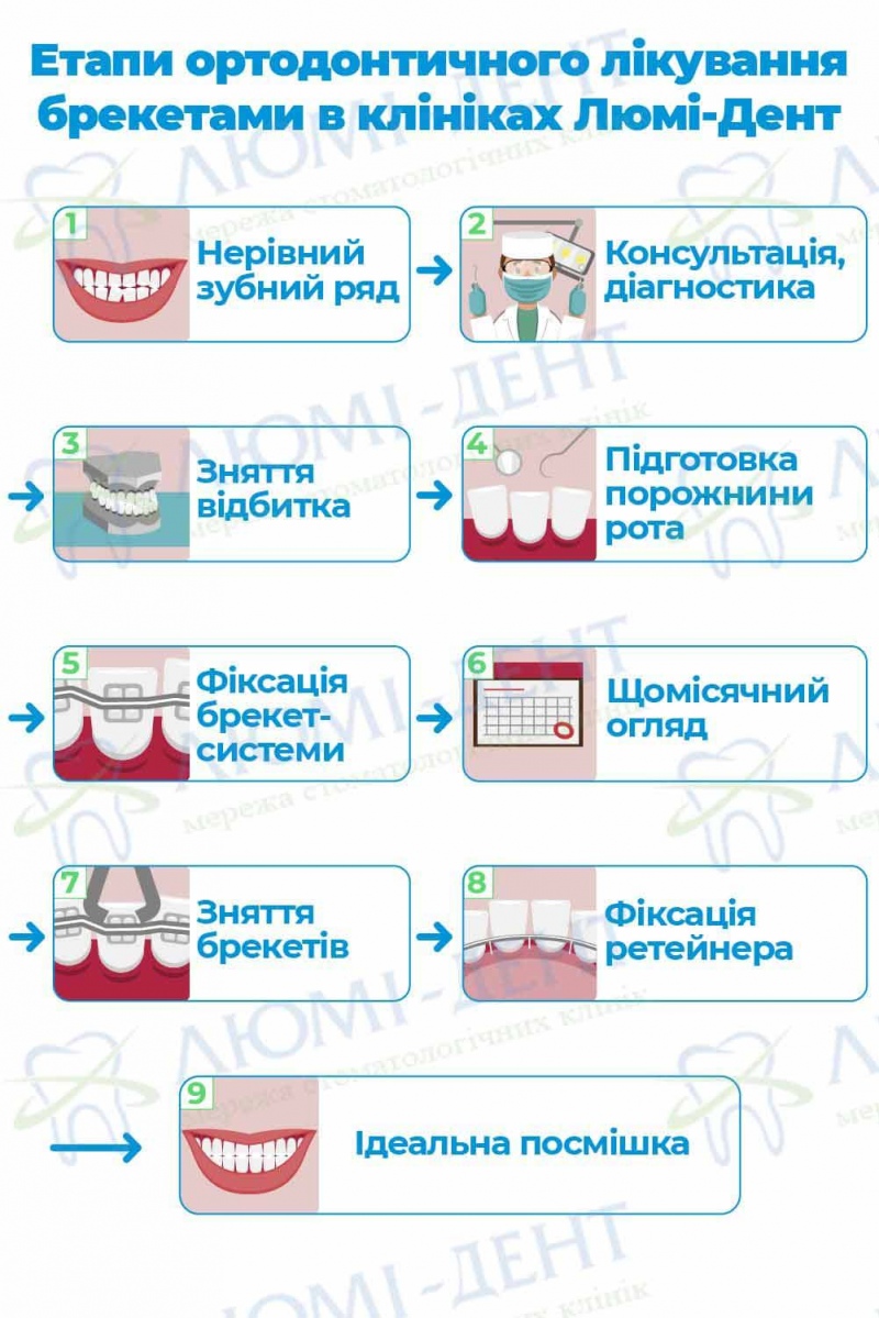 Етапи встановлення брекетів у клініках Люмі-Дент Етапи виправлення прикусу зубів Люмі-Дент