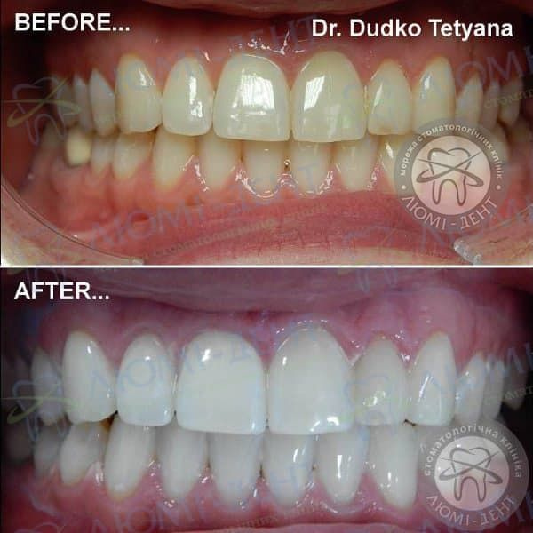 Відбілювання зубів вдома фото до і після Люмі-Дент
