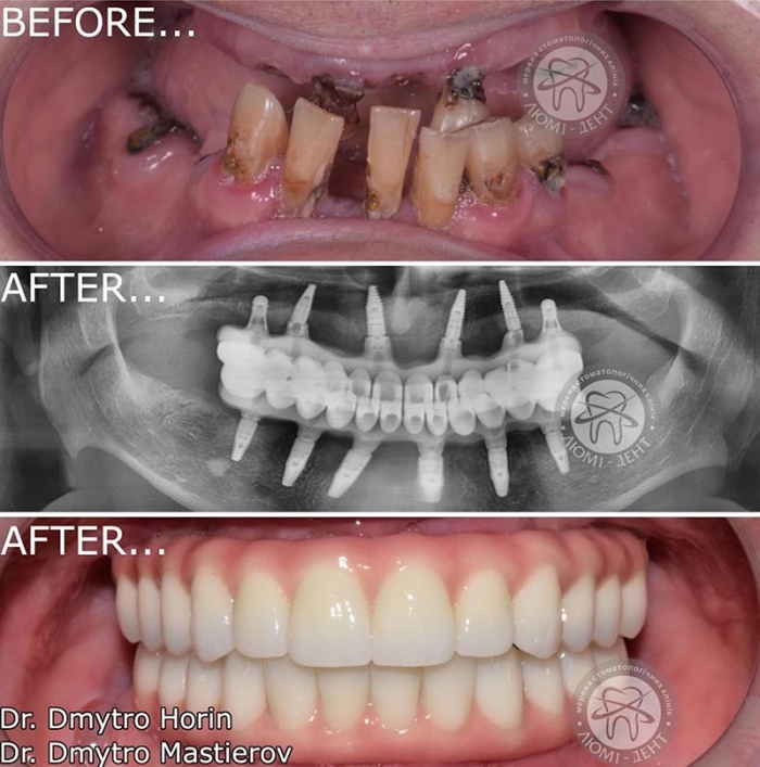 Имплантация зубов фото Люми-Дент