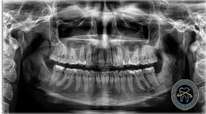 Ортопантомограмма зубов челюсти фото Люмидент