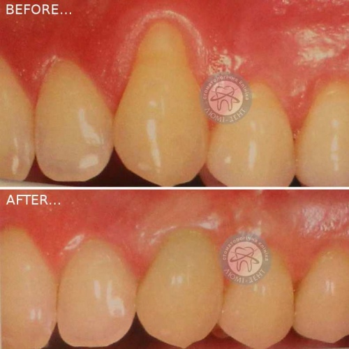 Лечение пародонтоза воспаления десен Киев фото Люми-Дент