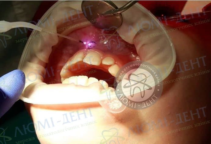 Пластика вуздечки верхньої губи у дорослих фото лікування Київ Люмі-Дент