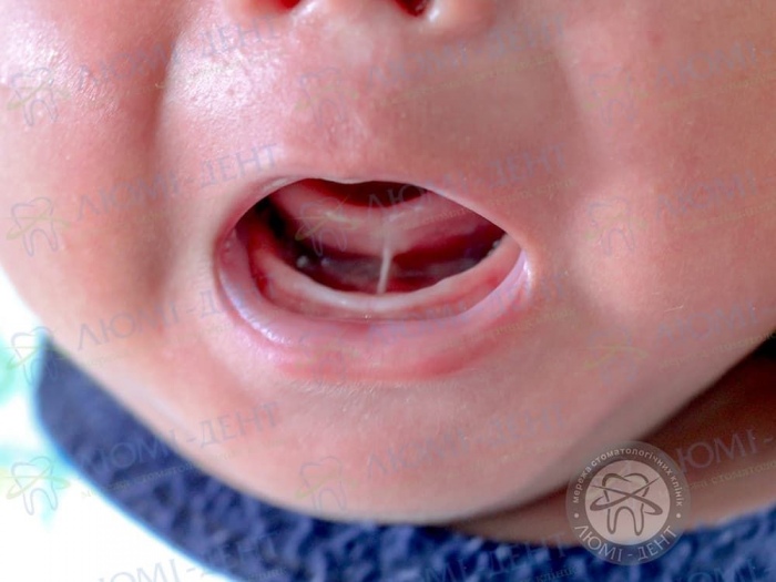 Підрізання вуздечки язика у дітей фото Люмі-Дент