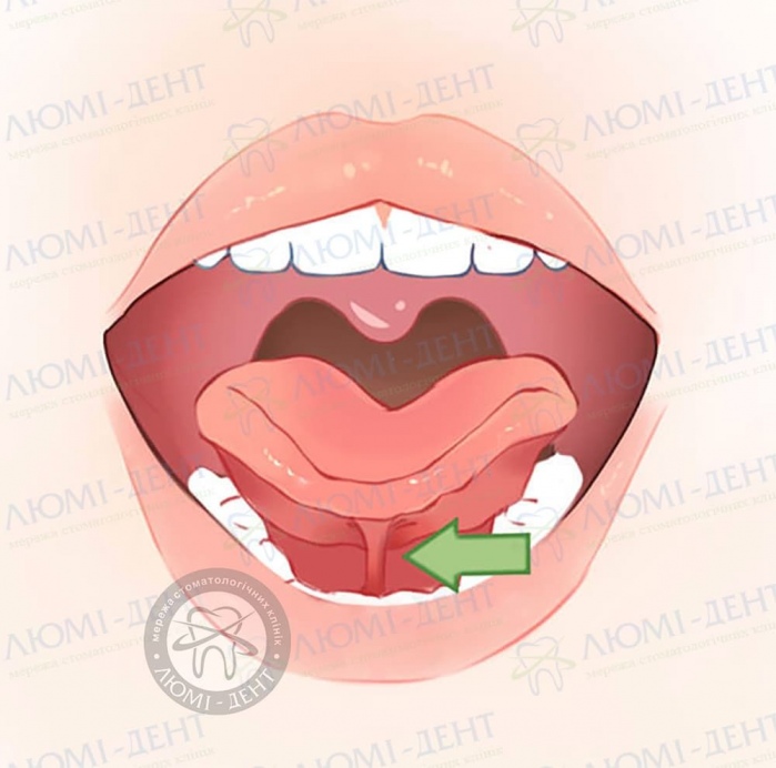 Підрізати вуздечку язика фото ЛюміДент