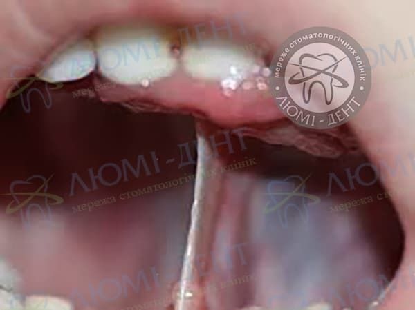 Скільки коштує підрізати вуздечку язика фото Люмі-Дент