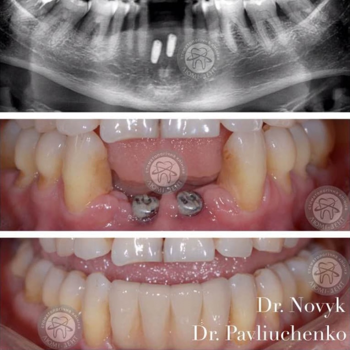 Немає зубів протезування імплантація фото Київ Люмідент