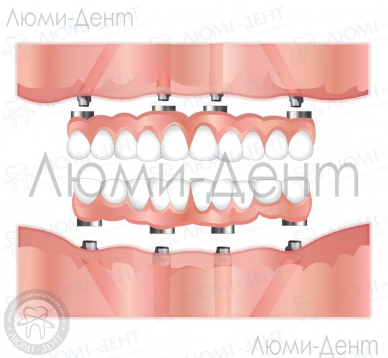 Незнімне протезування міст на імплантах фото Люмі-Дент