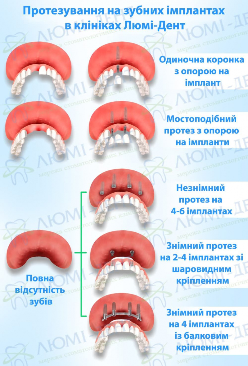 Як встановлюють імплант зуба фото Люмі-Дент