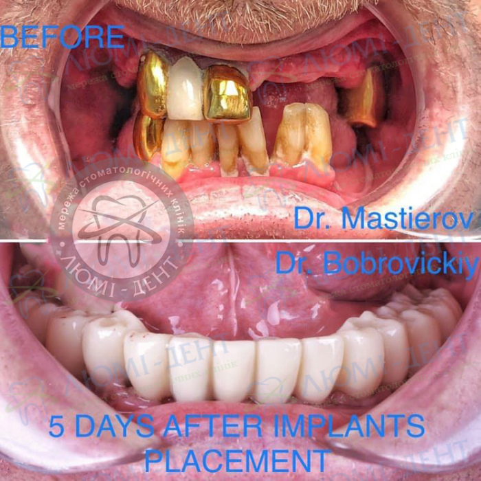 Зубные протезы на имплантах фото до и после Киев Люми-Дент 