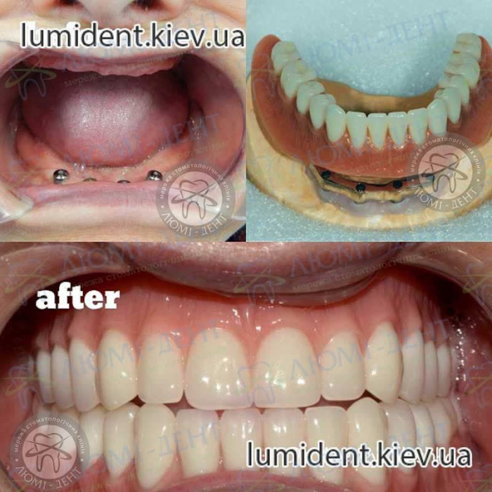 Несъемные зубные протезы на имплантах цена фото Киев  Люми-Дент