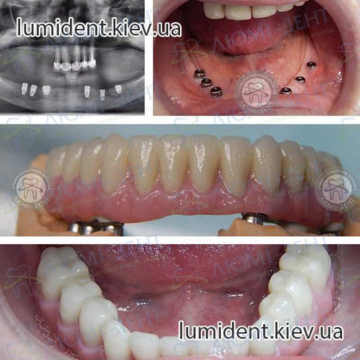 Несъемные зубные протезы на имплантах цена фото Киев  Люми-Дент