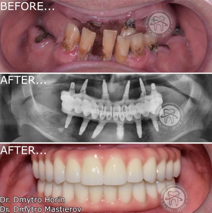 Протезирование зубов цена Киев фото до и после Люми-Дент