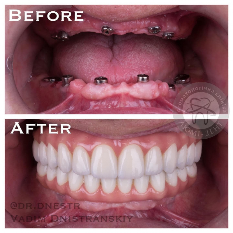 Протезування зубів ціна Київ фото до та після Люмі-Дент