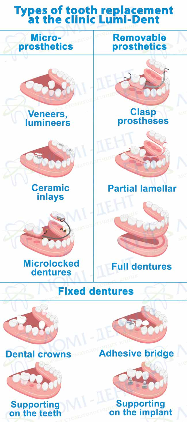 Crowns on teeth types of photo Lumi-Dent