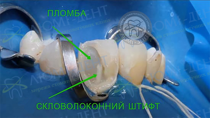 Відновлення зруйнованого зуба Київ фото Люмі-Дент