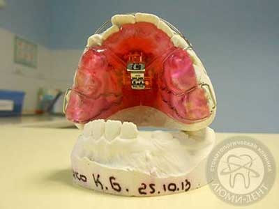 съемные платины на зубы для выравнивания зубов Киев Люми-Дент