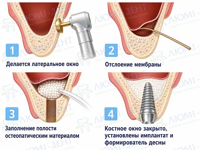 Открытый синус лифтинг - этапы