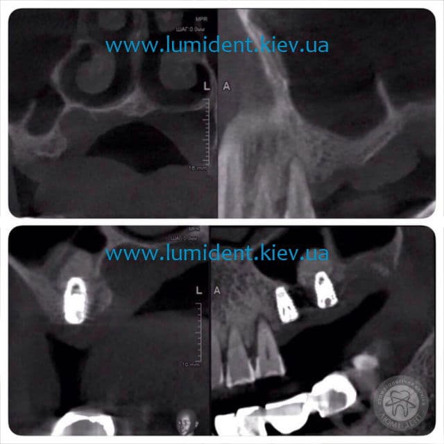 Пример имплантации фото Люми-Дент