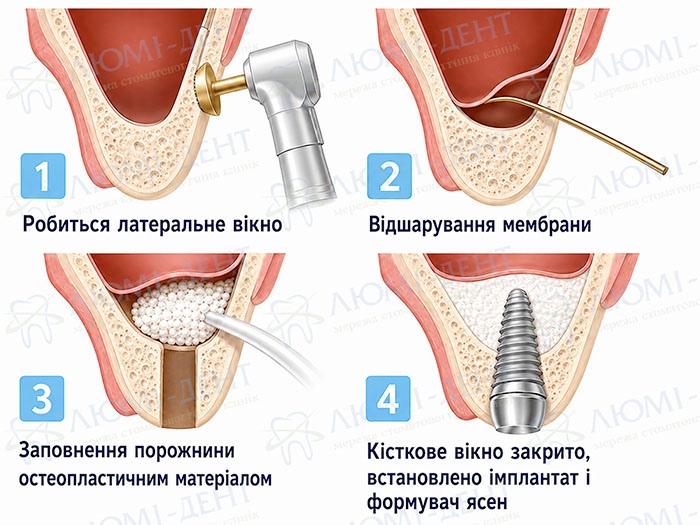Відкритий синус-ліфтинг - етапи Відкритий синус-ліфтинг - етапи