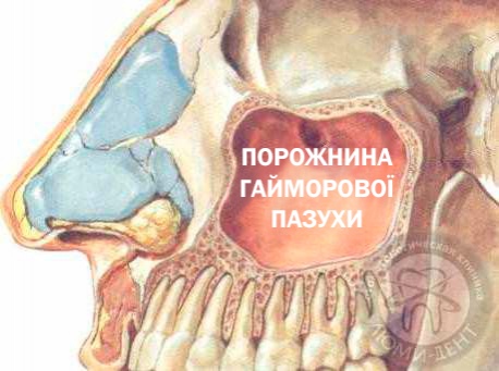 Операція синус ліфтинг фото Люмі-Дент