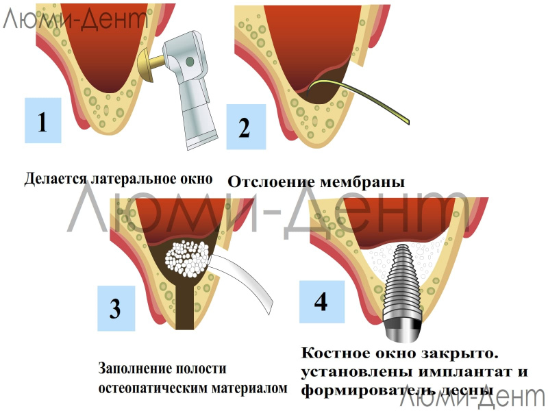 Открытый синус лифтинг