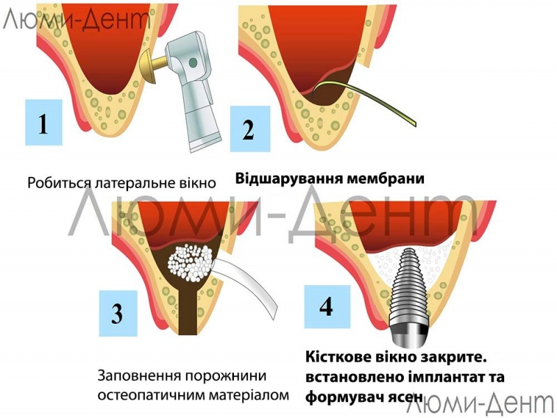Відкритий синус ліфтинг фото Люмі-Дент