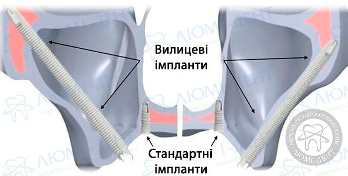Вилицева імплантація зубів фото ЛюміДент