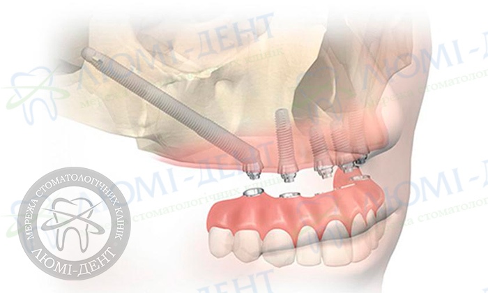 Зигоматичні імпланти фото ЛюміДент