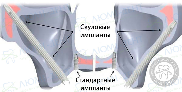 Скуловая имплантация зубов фото ЛюмиДент