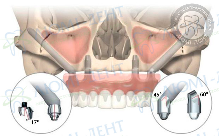 Скуловые импланты Zygoma фото ЛюмиДент