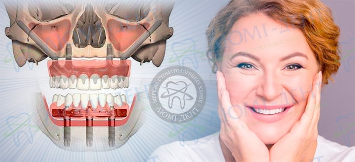 Скуловой имплант Zygoma — строение и длина конструкции Скуловой имплант Zygoma — строение и длина конструкции