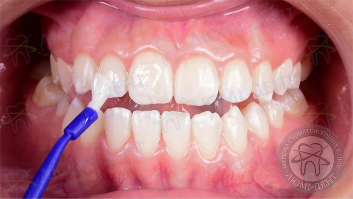 Deep fluoridation photo Lumi-Dent