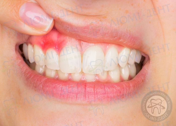 Лечение десен и слизистой рта фото Люми-Дент