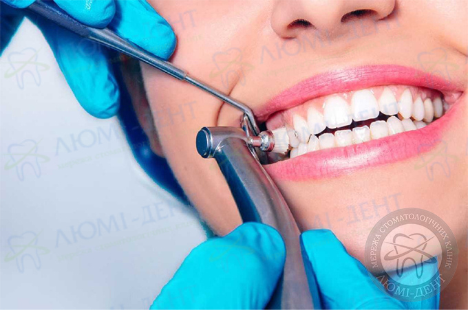 Professional dental cleaning photo Lumi-Dent
