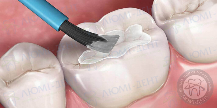 Fissure sealing procedure photo Lumi-Dent