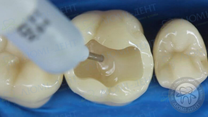 Treatment and filling procedures photo Lumi-Dent