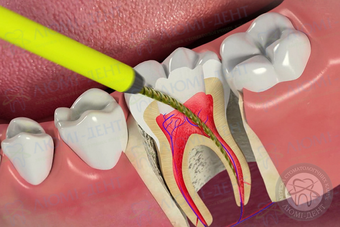 Canal treatment procedures photo Lumi-Dent